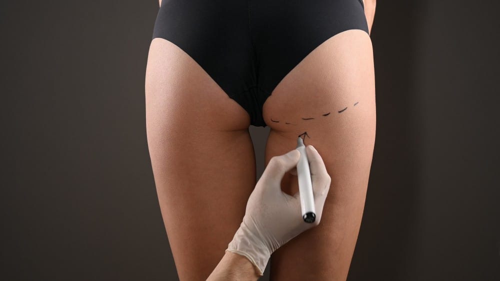 Qual o Melhor Procedimento para Aumentar os Gluteos 1