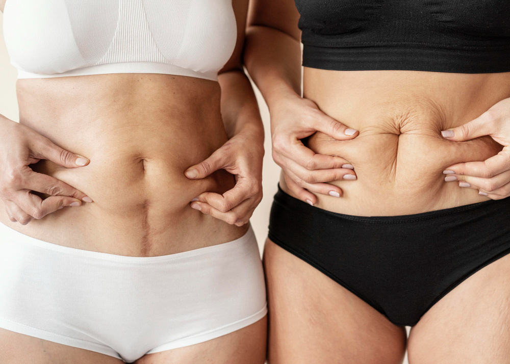 Quanto Tempo Dura uma Abdominoplastia com Lipo? 2 Quanto Tempo Dura uma Abdominoplastia com Lipo 3