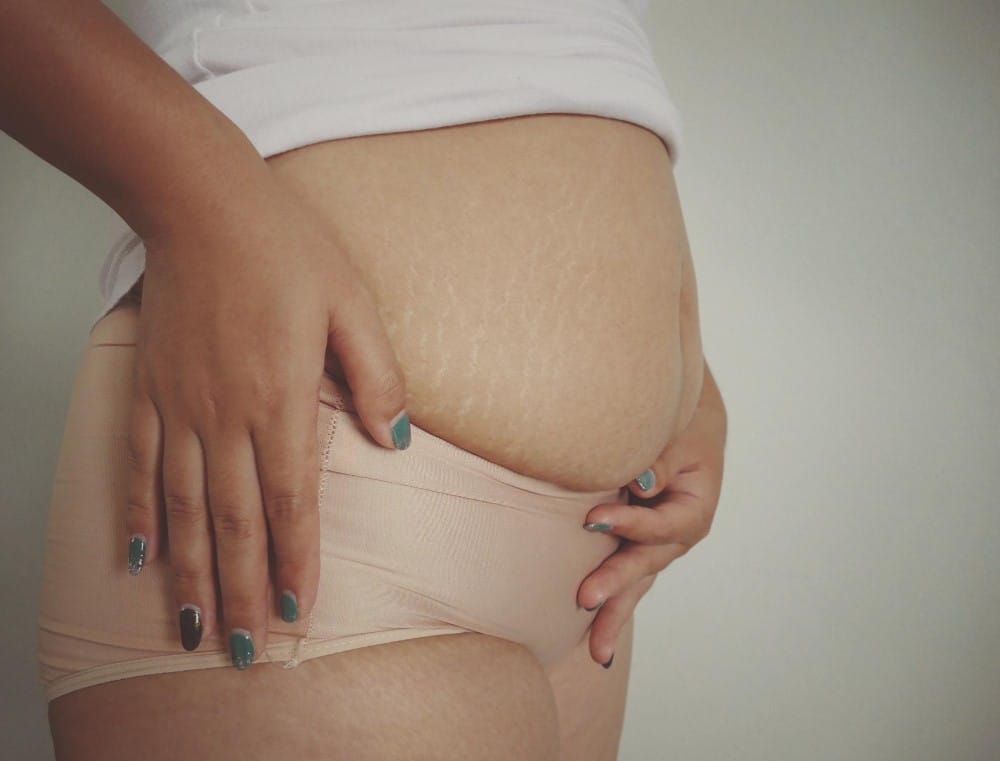 Abdominoplastia Pos Parto 2