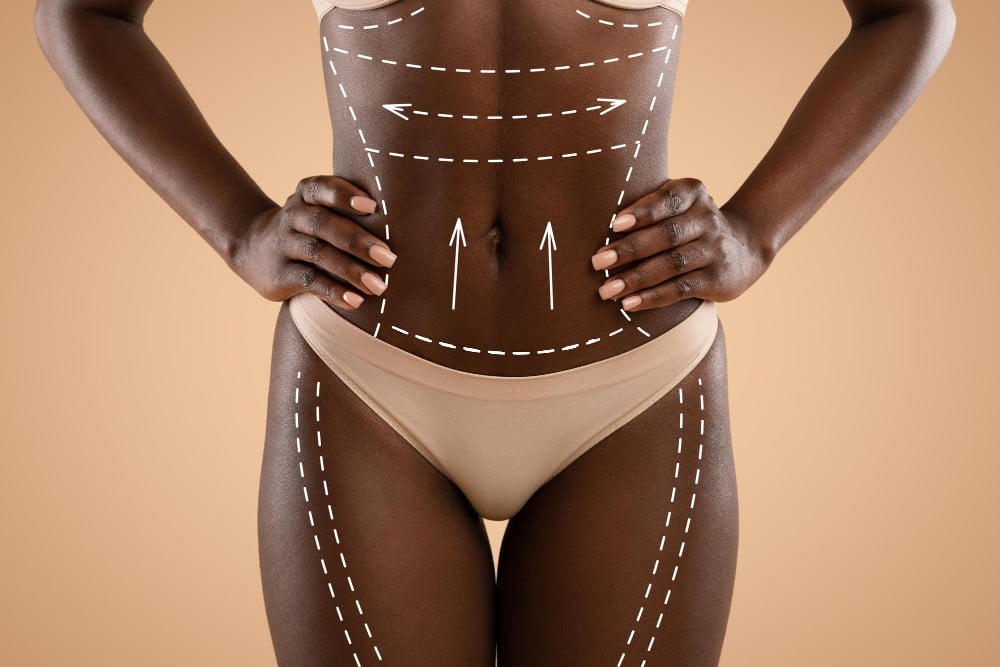 Areas do Corpo para Lipoaspiracao 2