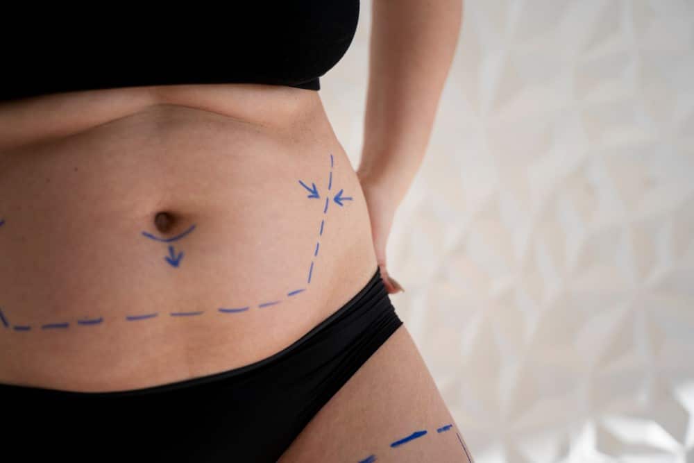 Cirurgia Plastica de Abdomen